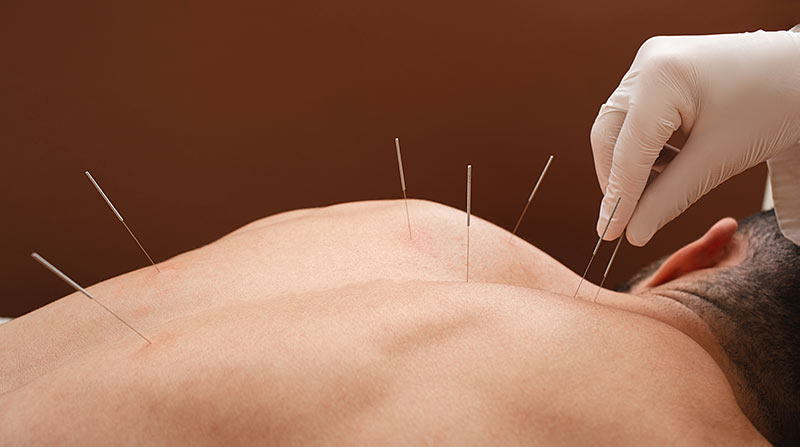 Akupunktur in bestimmte Stellen des Rückens
